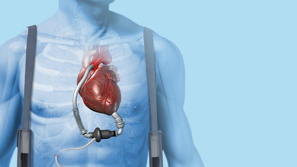Cardiac Assist Device Market