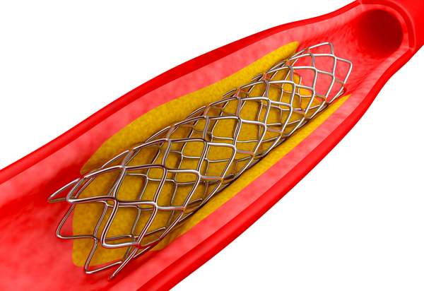 India Coronary Stent market