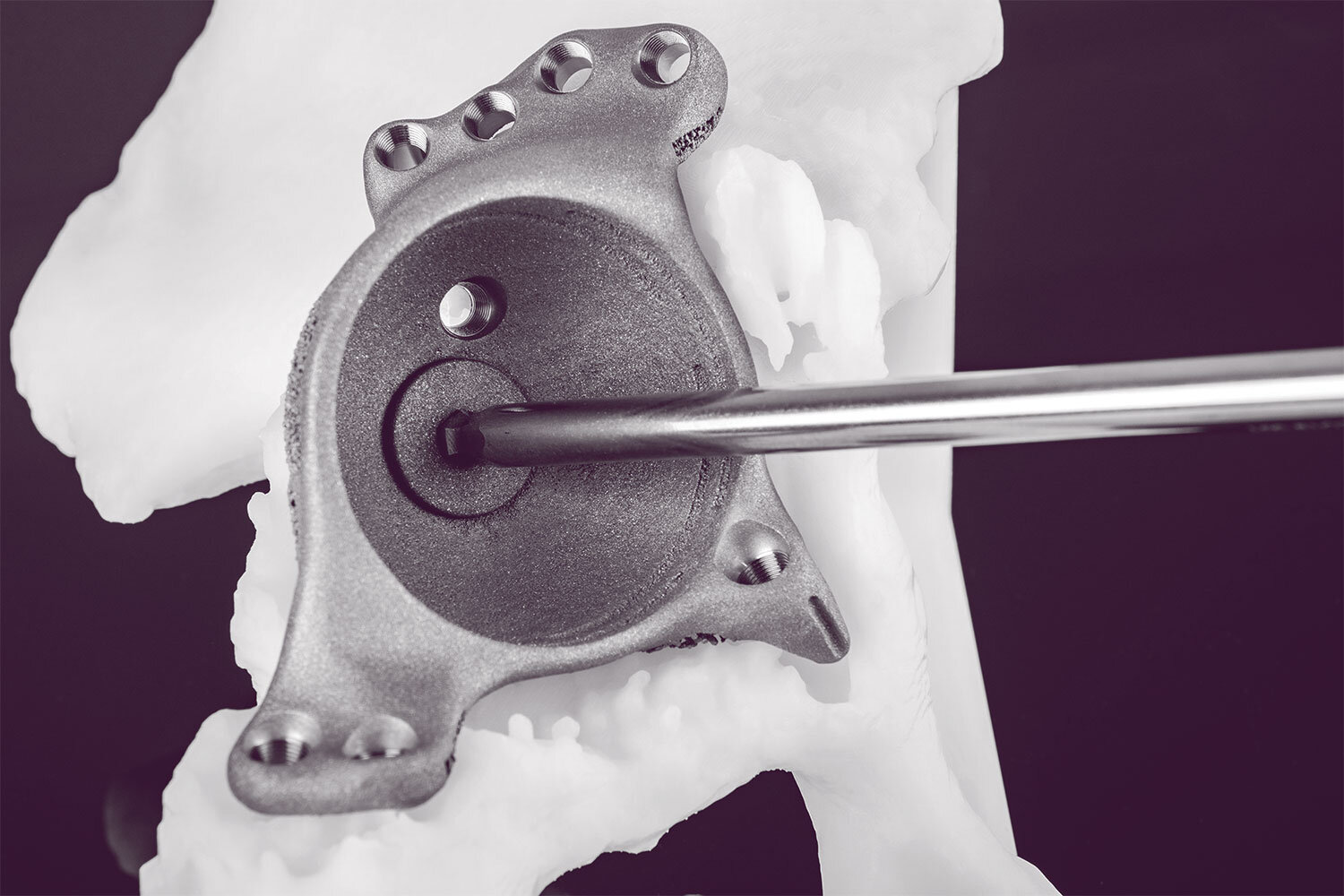 Personalized Orthopaedic Implant market