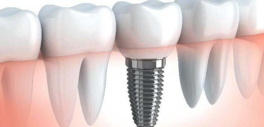 Bio-Implants Market