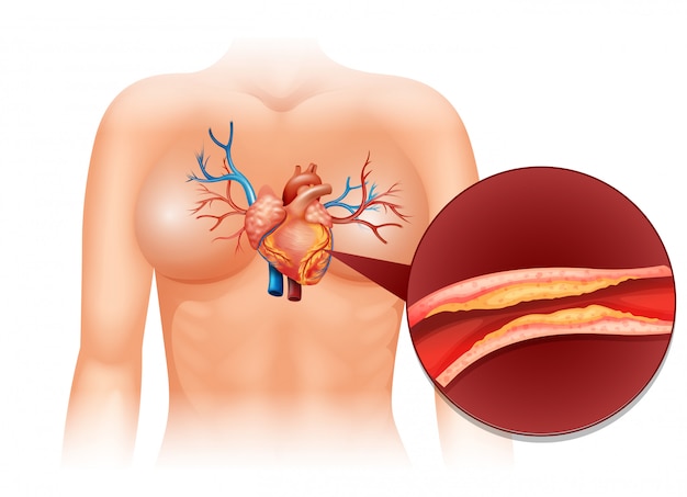 Indian Coronary Stent Market