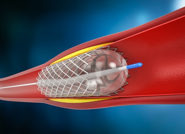 Neurovascular Stent Retrievers Market