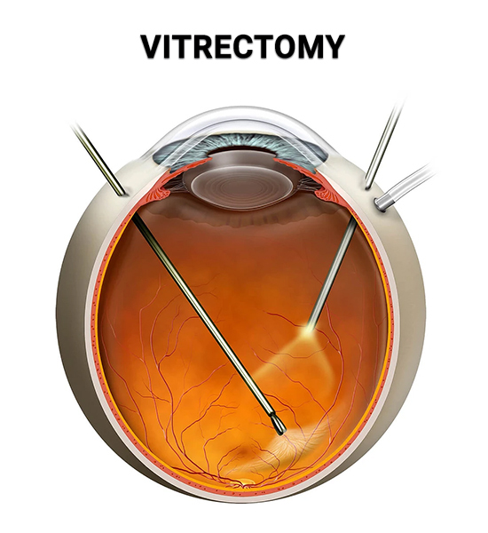 Vitrectomy Devices Market