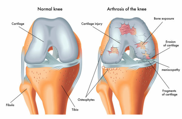 Cartilage Repair Market