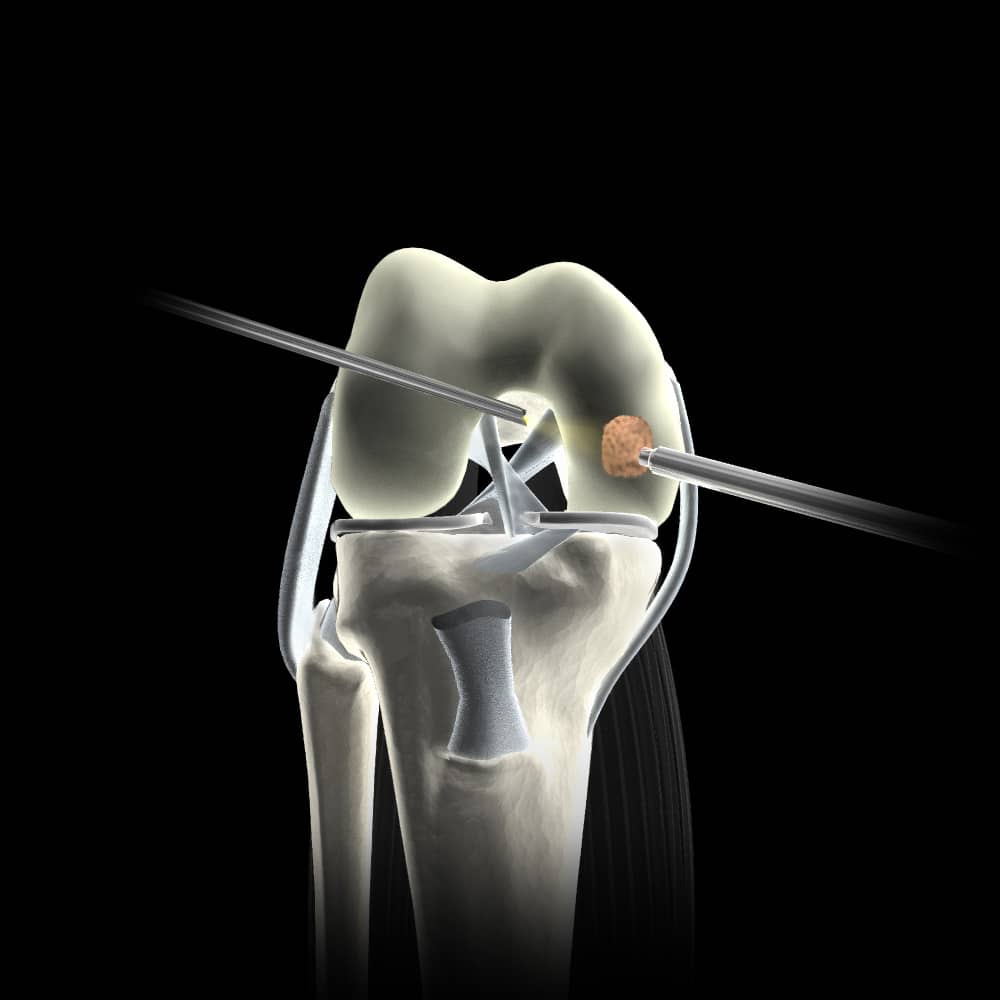 Cartilage Repair Market