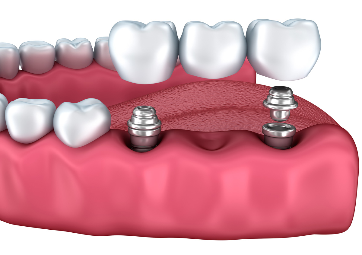 Cosmetic Implants Market