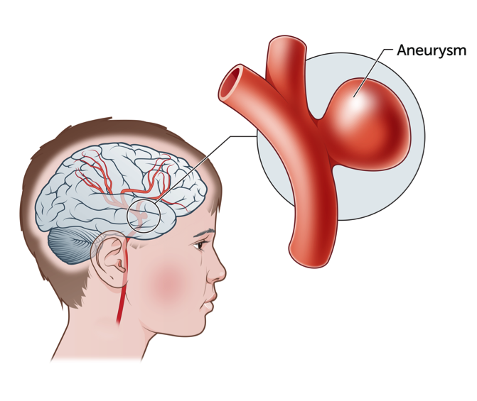 Intracranial Aneurysm Market