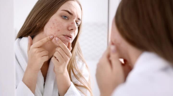 Moderate-to-Severe Acne Treatment Market