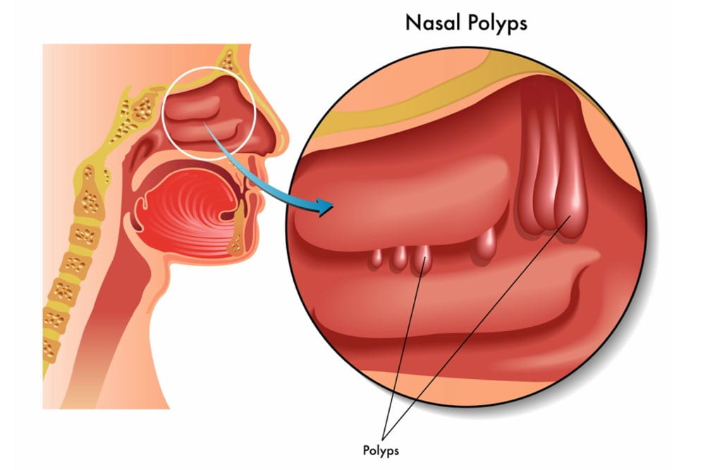 Nasal Polyposis Treatment Market