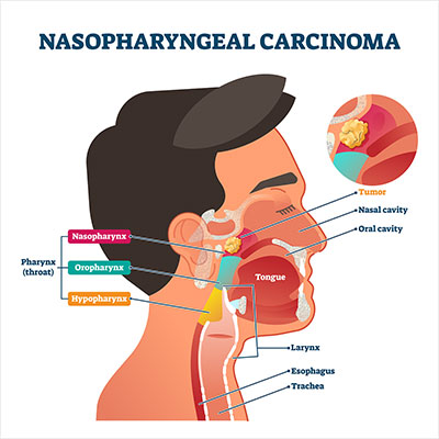 Nasopharyngeal Carcinoma Treatment Market