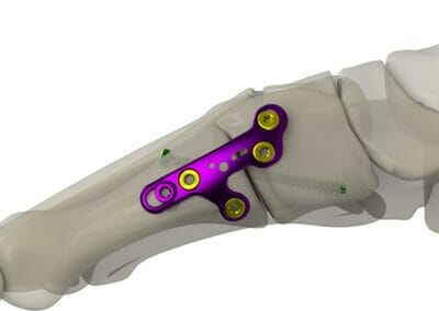 Osteotomy Plates Market