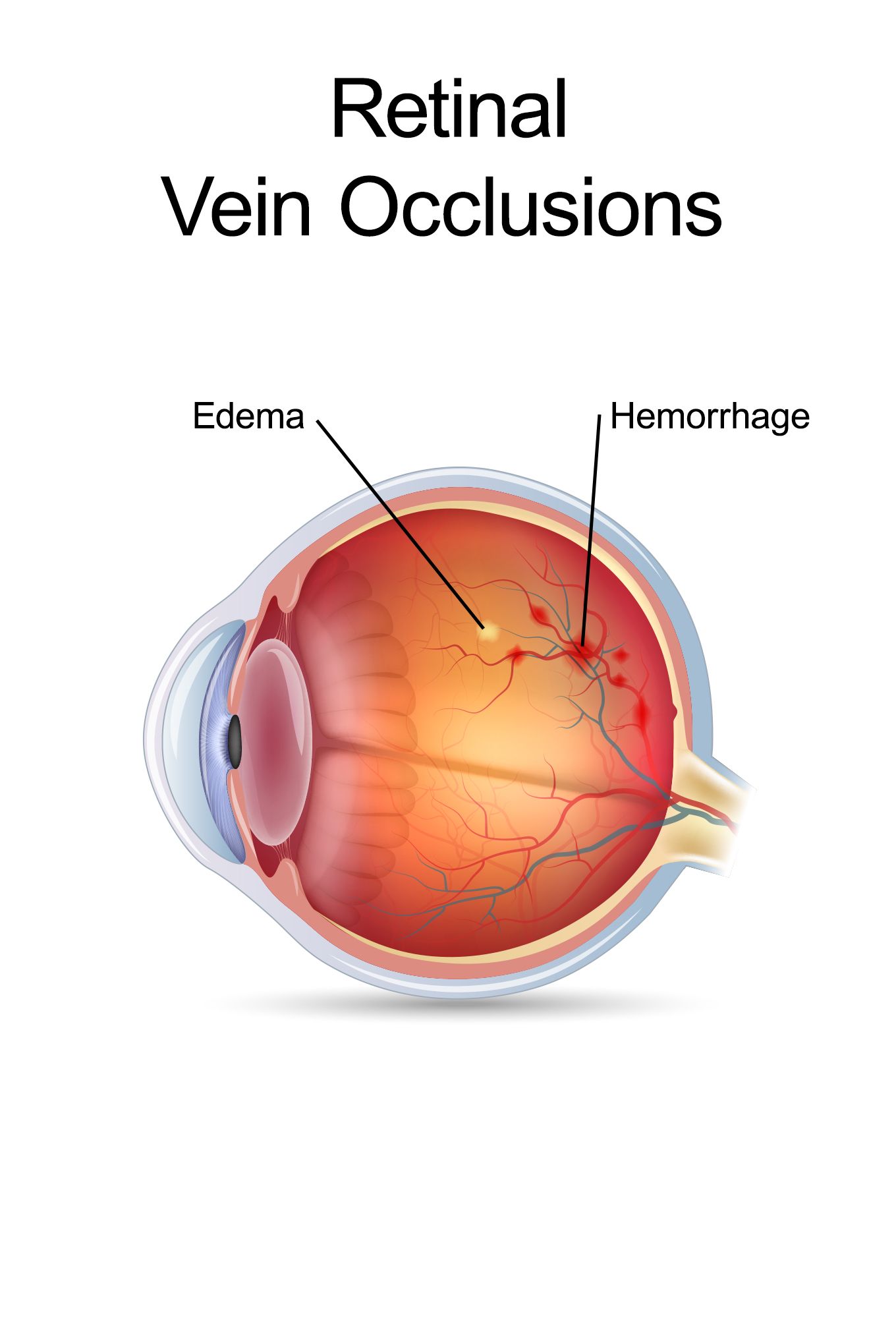 Retinal Vein Occlusion Treatment Market