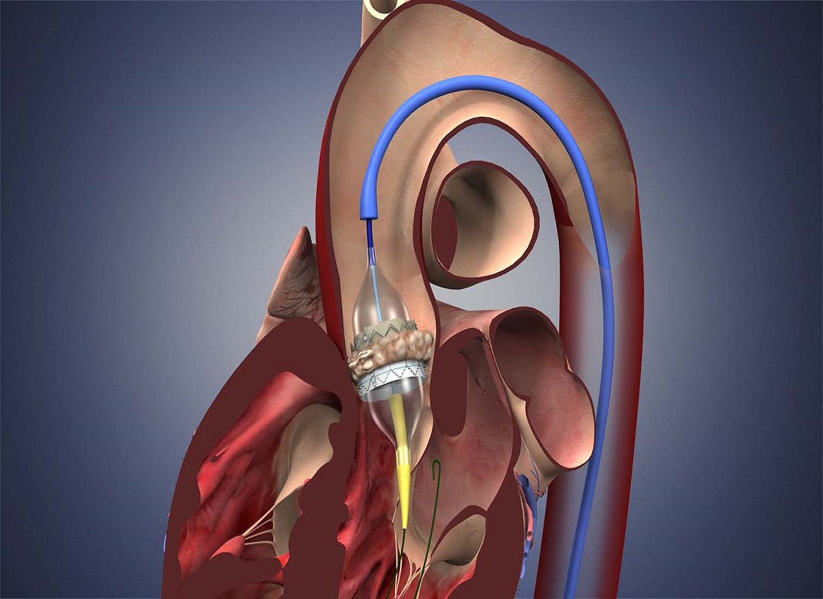 Transcatheter Heart Valve Replacement (TAVR) Market