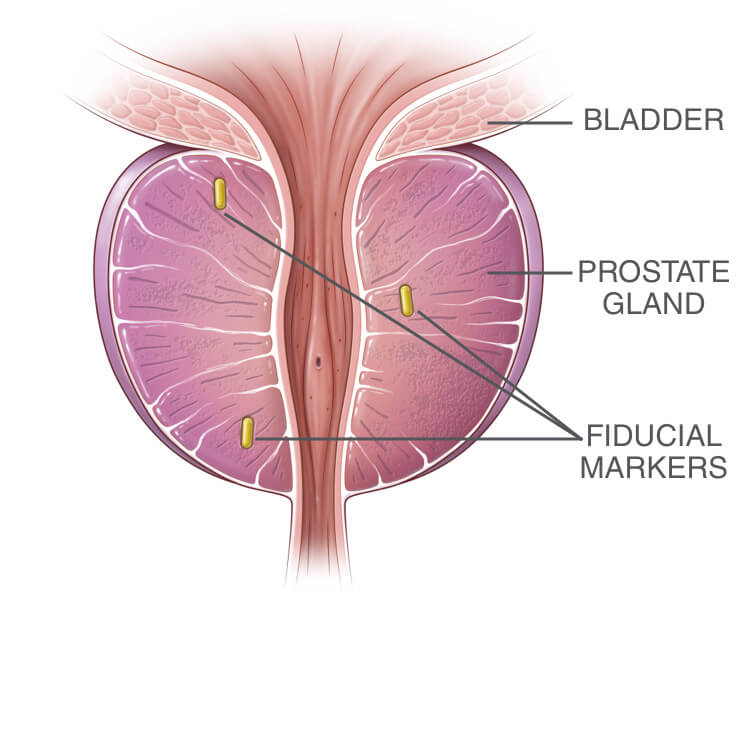 fiducial markers