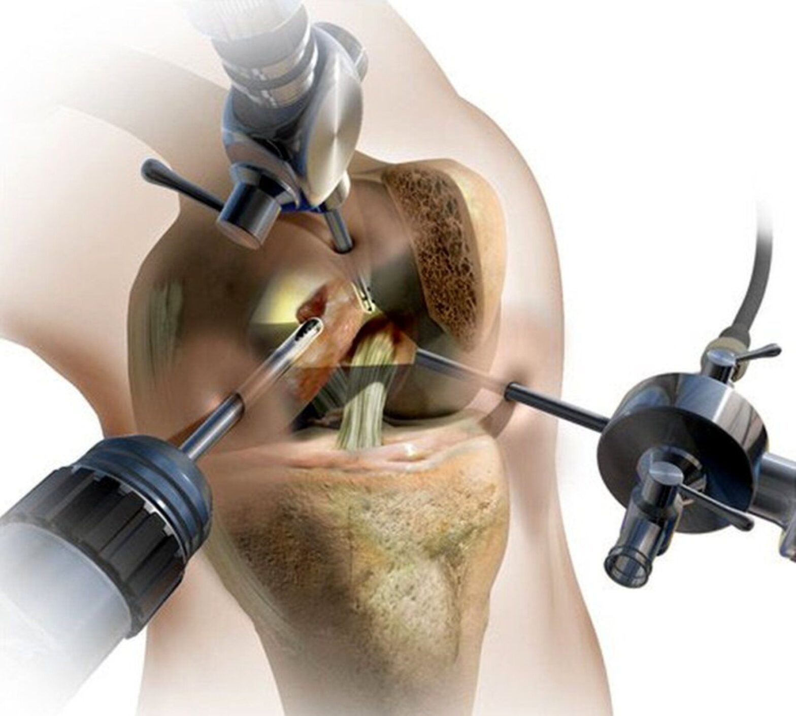 Arthroscopy Visualization Systems Market