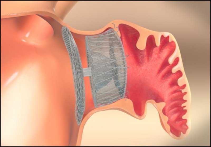 Atrial Appendage Occluder Market