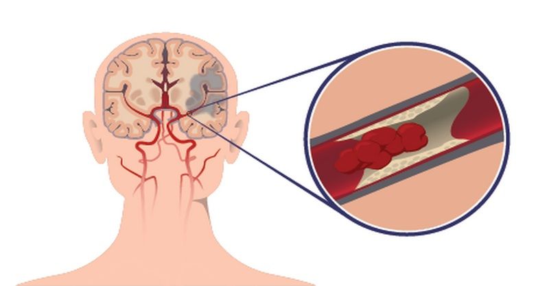 Cerebral Vein Thrombosis Treatment Market