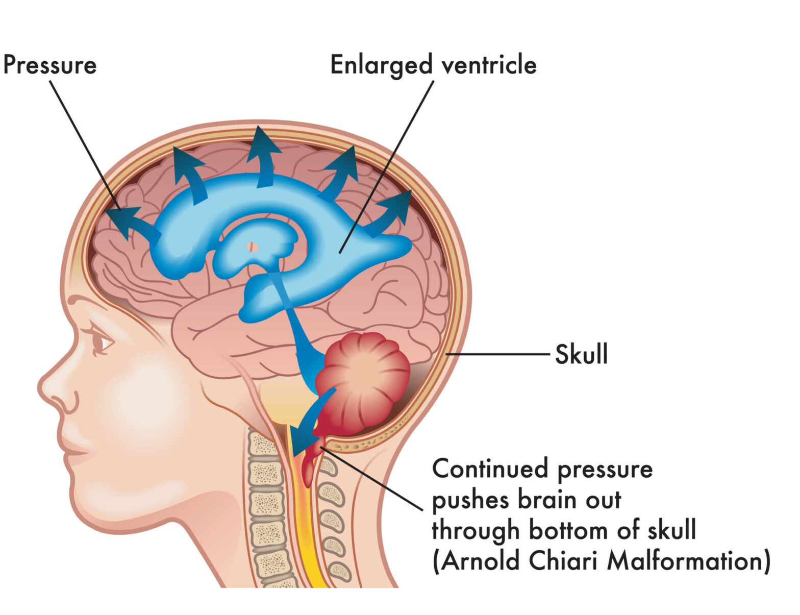 Chiari Malformation Treatment Market