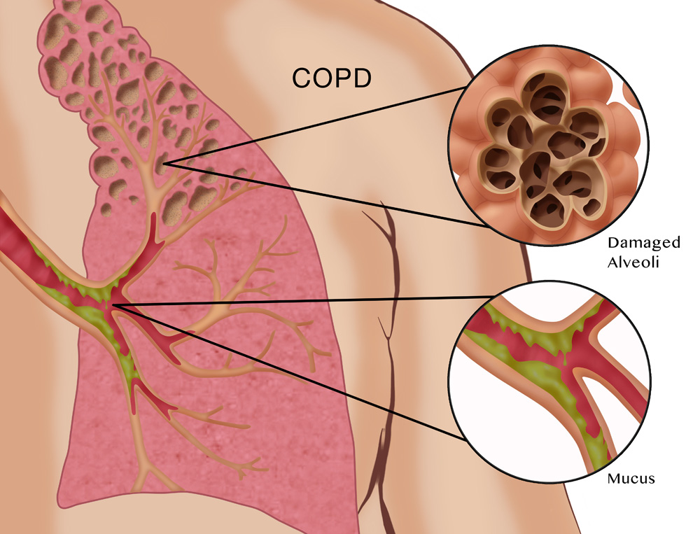 Chronic Obstructive Pulmonary Disease (COPD) Market