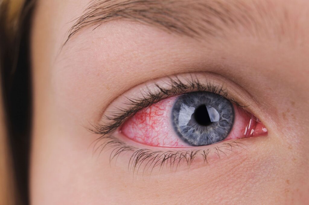 Dry Eye Syndrome Treatment Market