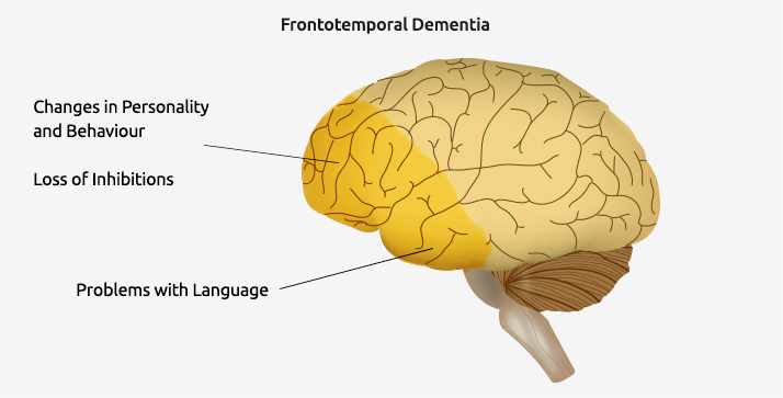 Frontotemporal Dementia Management Market