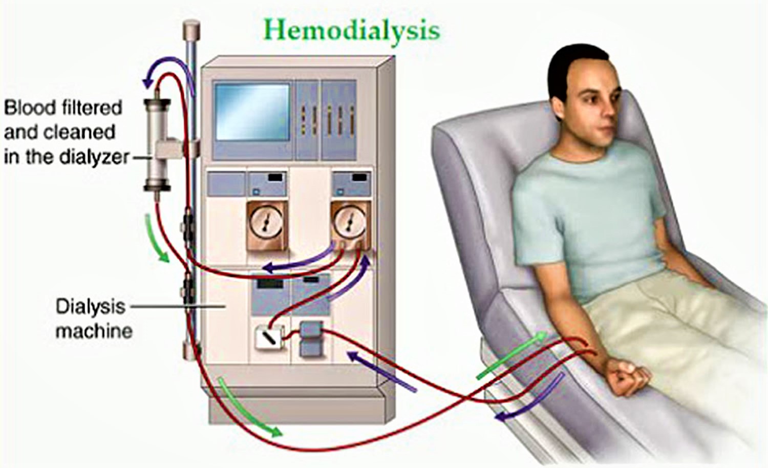 Home Dialysis Systems Market