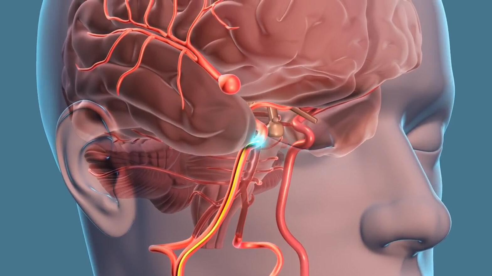 Intracranial Aneurysm Market