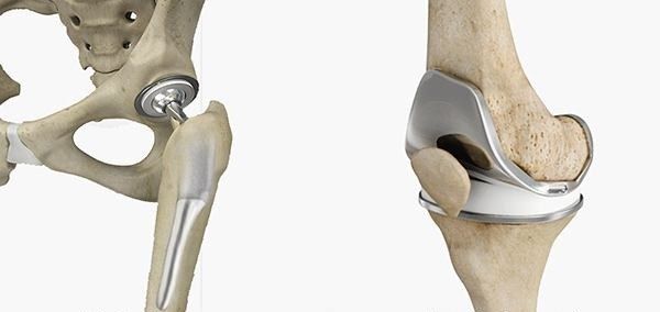 Joint Replacement Market