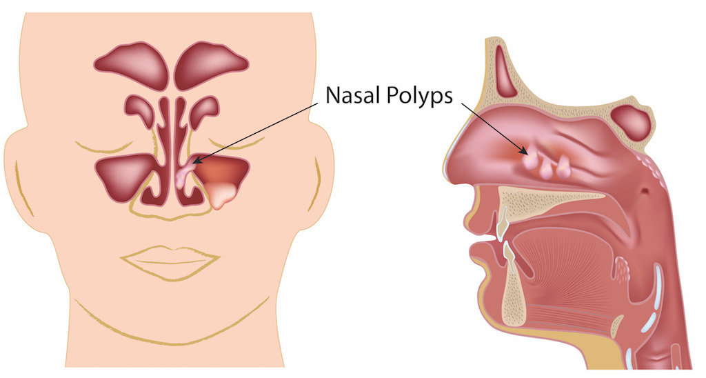 Nasal Polyposis Treatment Market