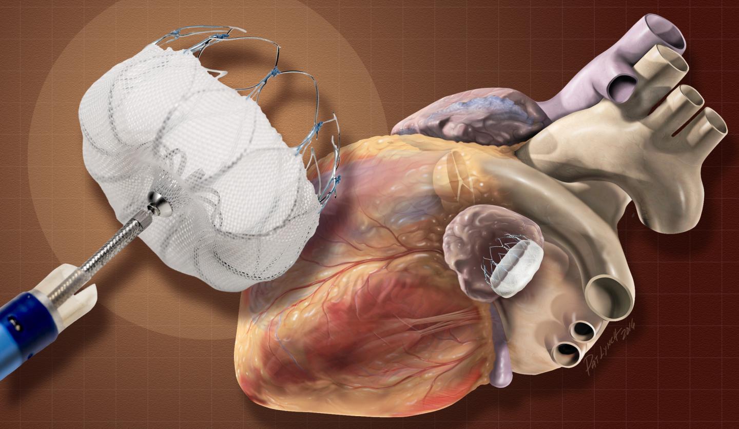 Neurovascular Devices / Interventional Neurology Market