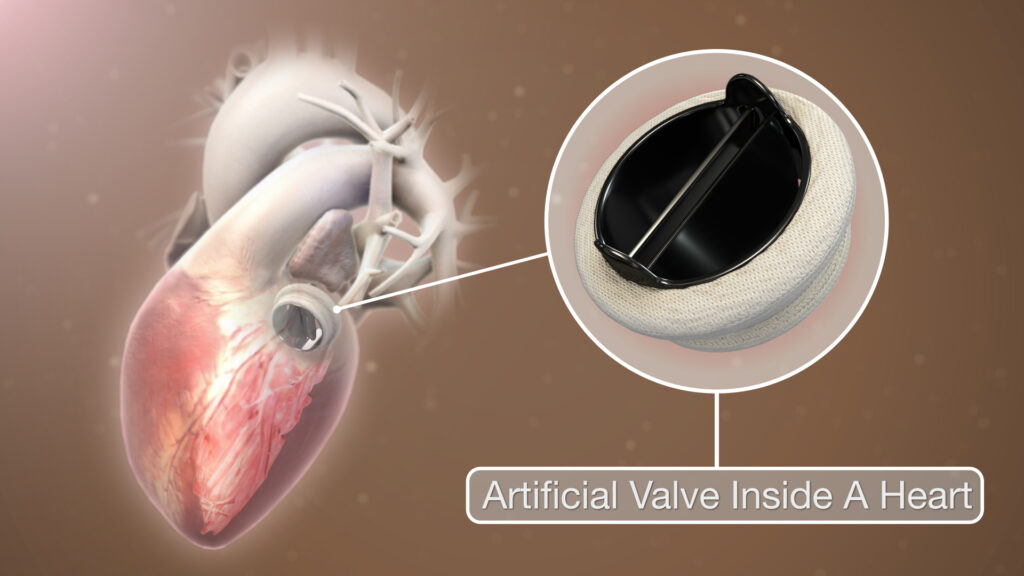 Prosthetic Heart Valve Market