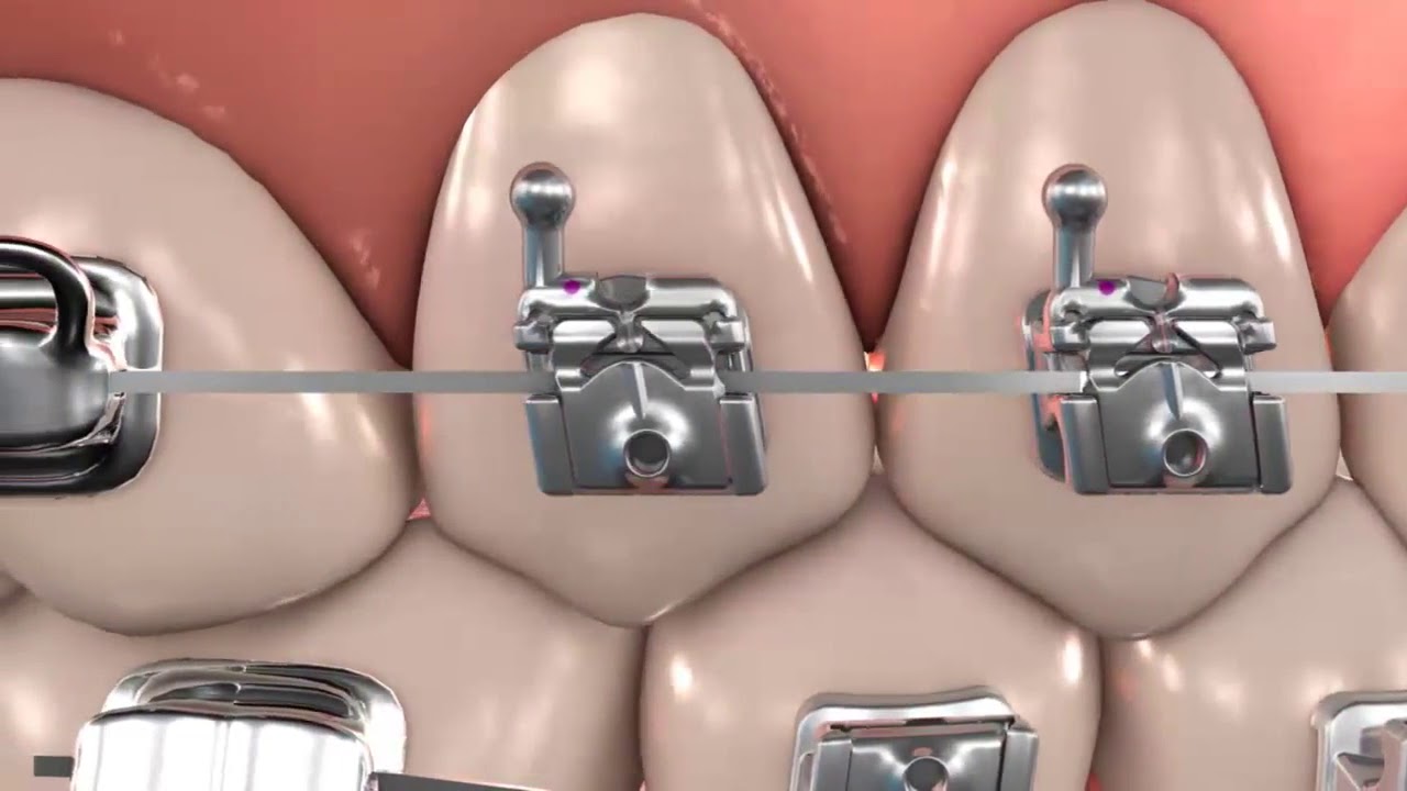 Self-Ligating Bracket Sales Market