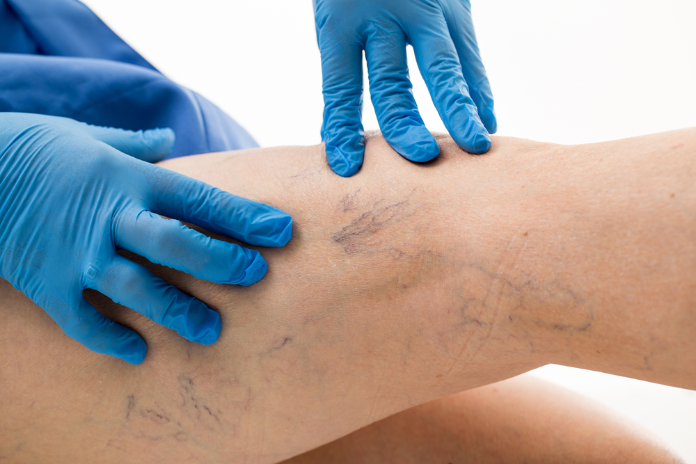 Varicose Vein Treatment Market