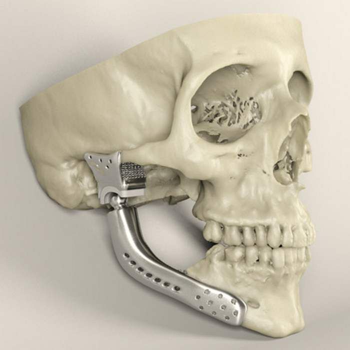 3D Printed Medical Implants Industry