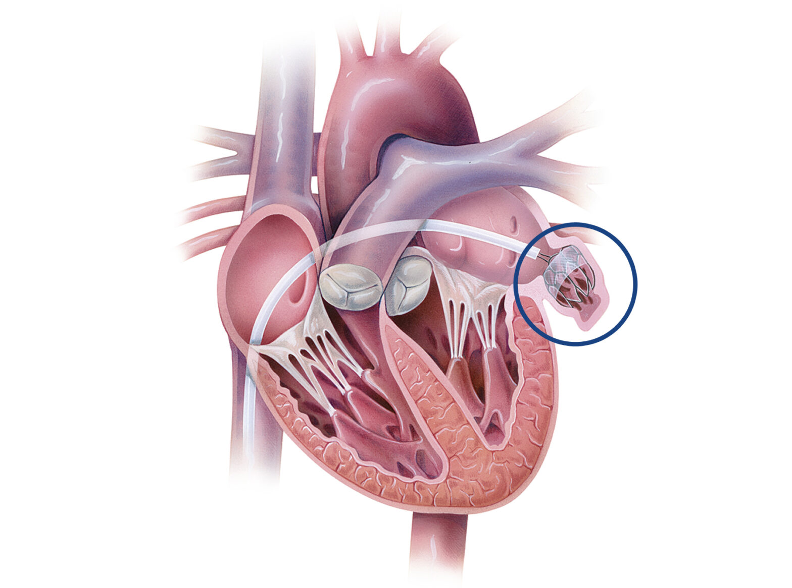 Atrial Appendage Occluder Industry