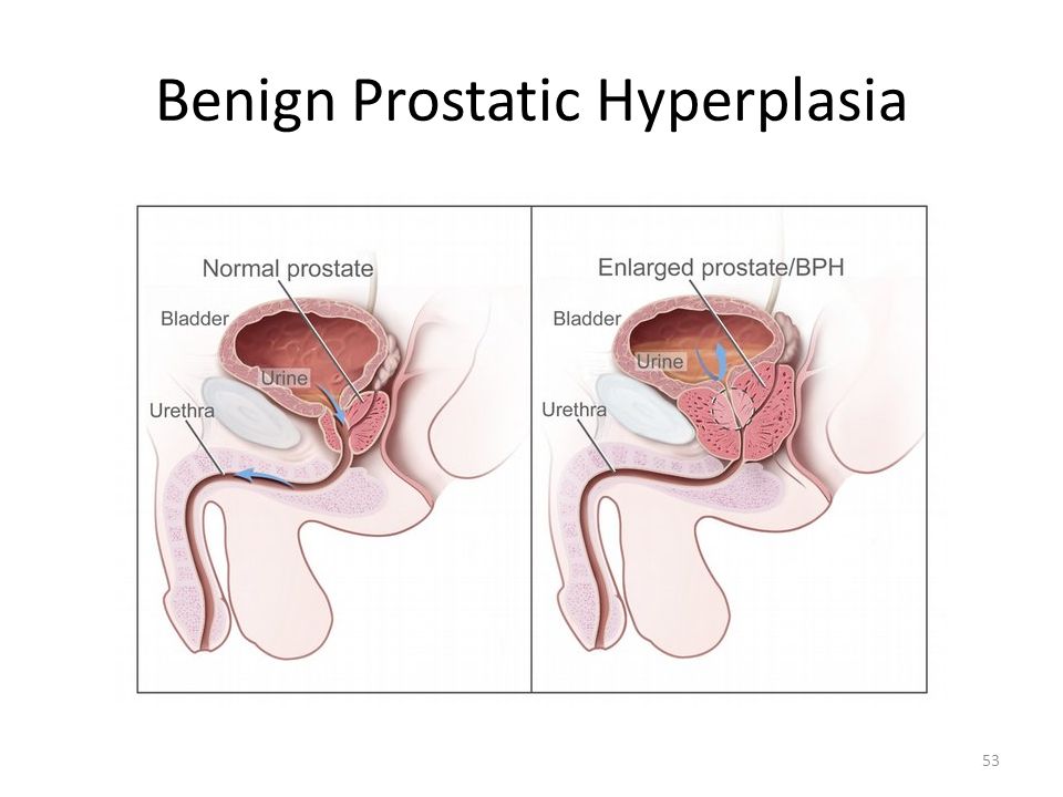 Benign Prostatic Hyperplasia (BPH) Prostate Treatment Market