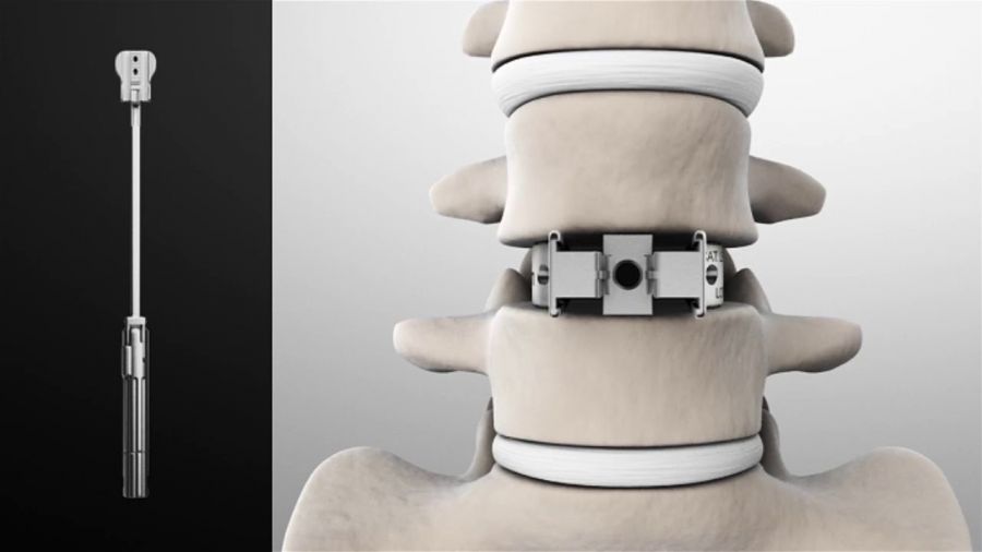 Cervical Spacer Systems Industry