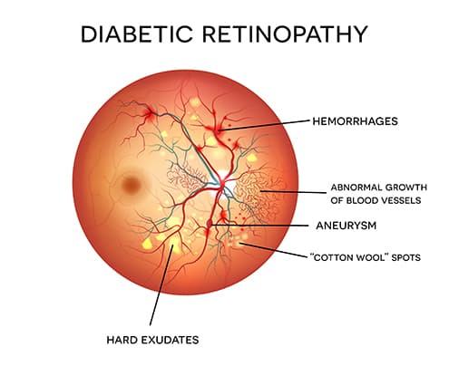 Global Diabetic Retinopathy Industry