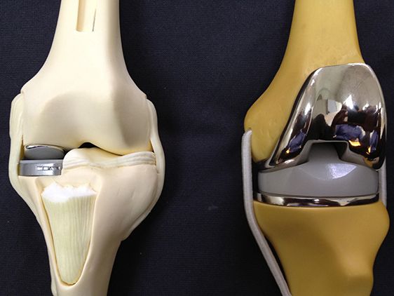Knee Replacement Industry