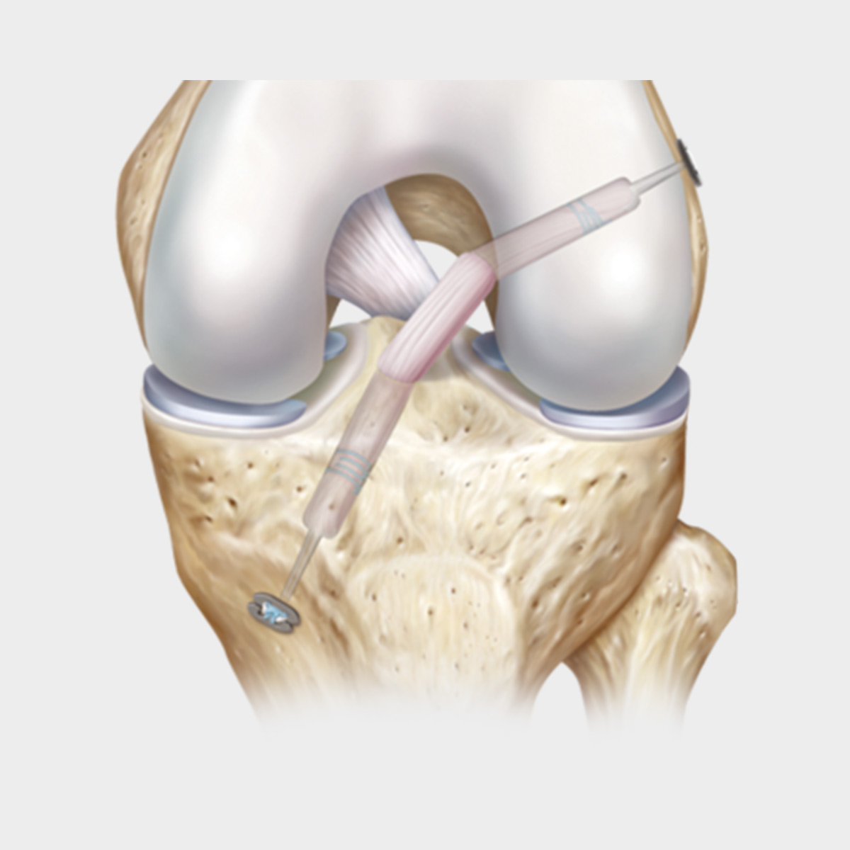 Ligament Augmentation Industry