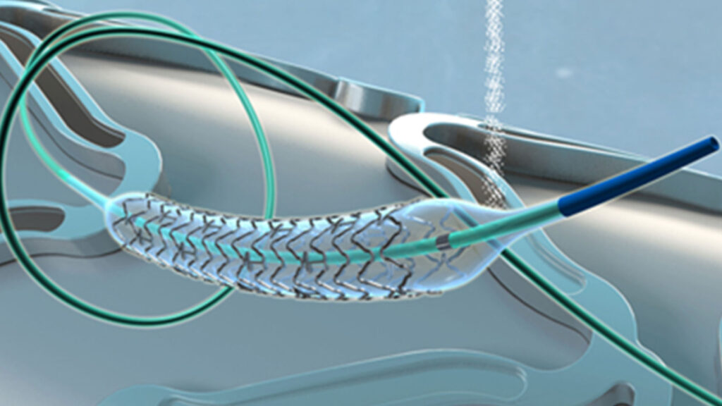 Global Neurovascular Guidewires Industry Set To Soar At 4.0% CAGR ...