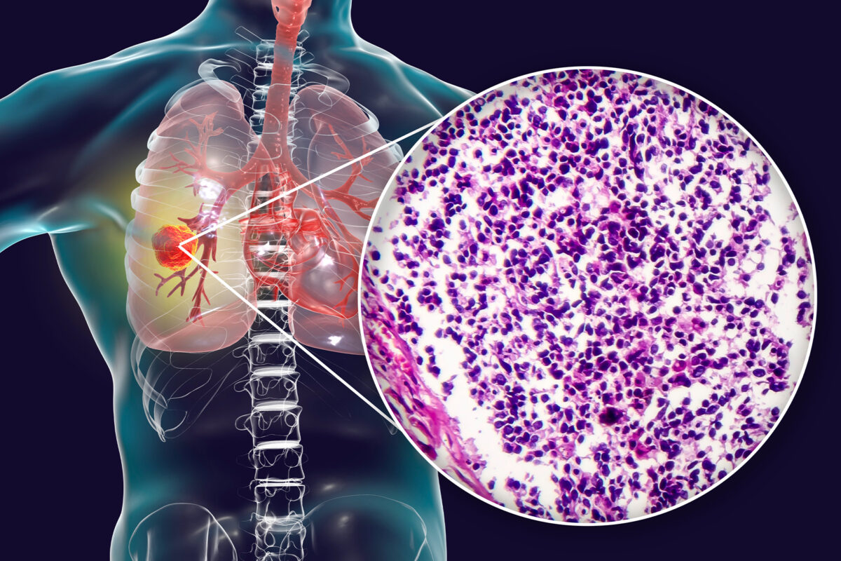 Non-Small Cell Lung Carcinoma (NSCLC) Industry