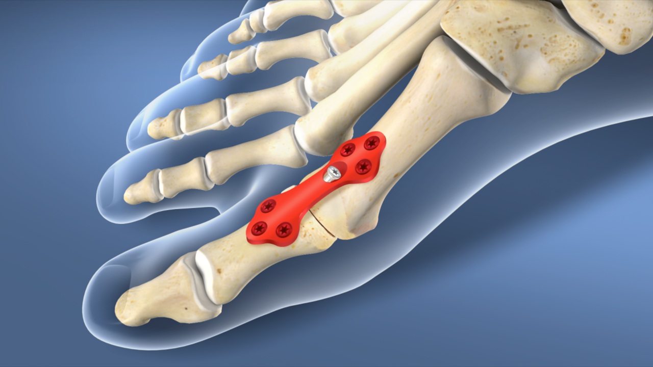 Osteotomy Plates Industry