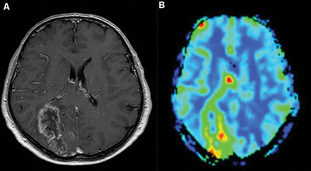 Perfusion Imaging Market