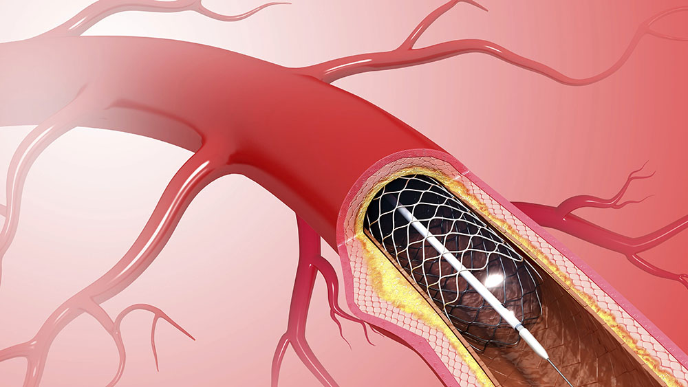 Peripheral Vascular Devices Industry