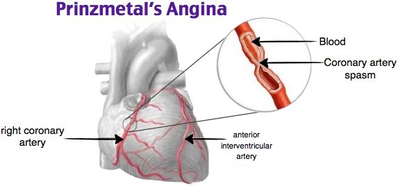 Prinzmetal Angina Therapeutics Market