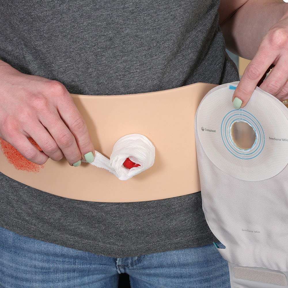 Stoma Ostomy Care Industry