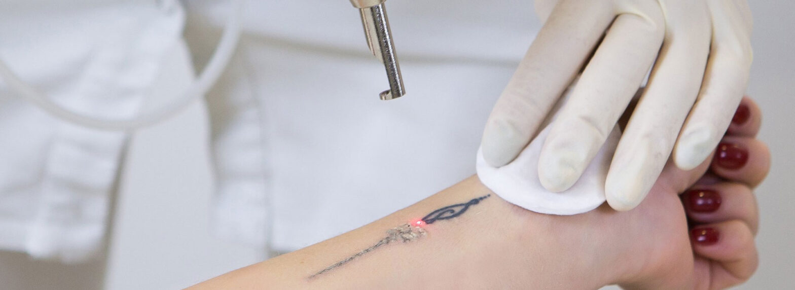 Tattoo Removal Lasers Market