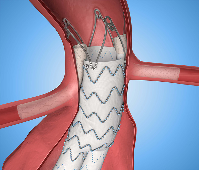 Thoracic Vascular Stent Grafts Market