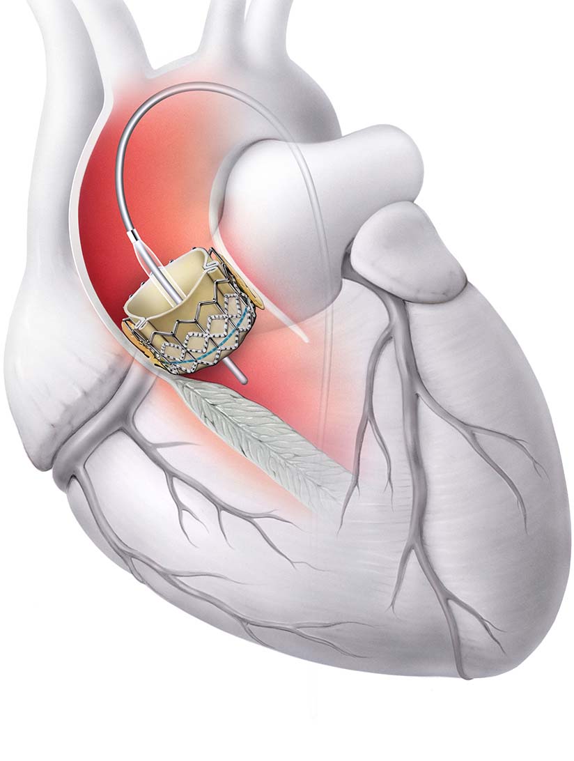 Transcatheter Heart Valve Replacement (TAVR) Industry